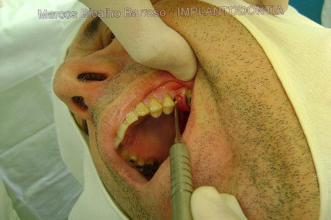 Implante Alvim Cone Morse - Instalação em 20 Minutos, Sem Retalho, Sem Sutura