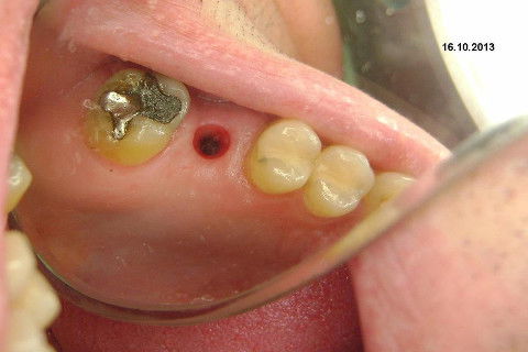 Implante Alvim Cone Morse - Instalação em 20 Minutos, Sem Retalho, Sem Sutura