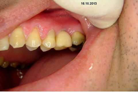 Implante Alvim Cone Morse - Instalação em 20 Minutos, Sem Retalho, Sem Sutura