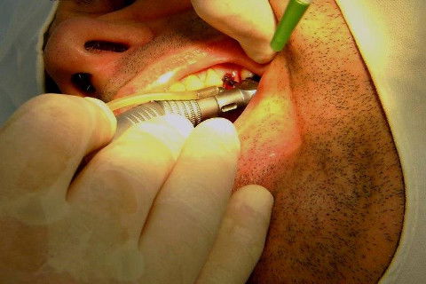 Implante Alvim Cone Morse - Instalação em 20 Minutos, Sem Retalho, Sem Sutura