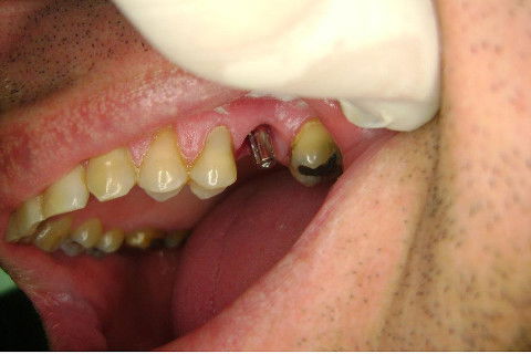 Implante Alvim Cone Morse - Instalação em 20 Minutos, Sem Retalho, Sem Sutura