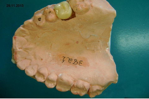 Implante Alvim Cone Morse - Instalação em 20 Minutos, Sem Retalho, Sem Sutura