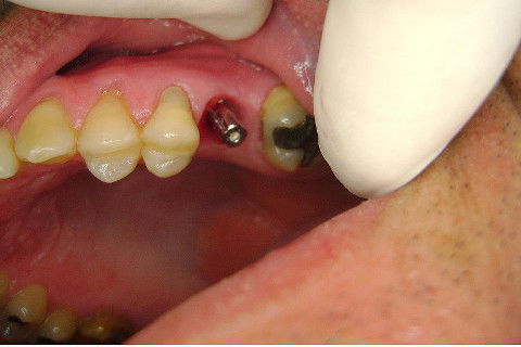 Implante Alvim Cone Morse - Instalação em 20 Minutos, Sem Retalho, Sem Sutura