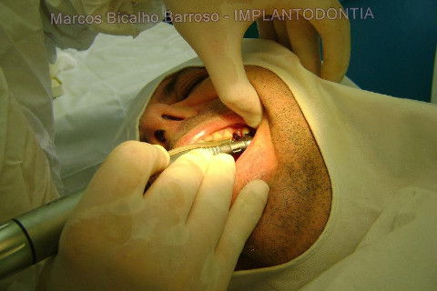 Implante Alvim Cone Morse - Instalação em 20 Minutos, Sem Retalho, Sem Sutura