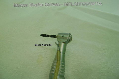 Implante Alvim Cone Morse - Instalação em 20 Minutos, Sem Retalho, Sem Sutura