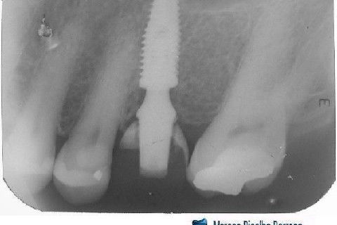 Implante Alvim Cone Morse - Instalação em 20 Minutos, Sem Retalho, Sem Sutura
