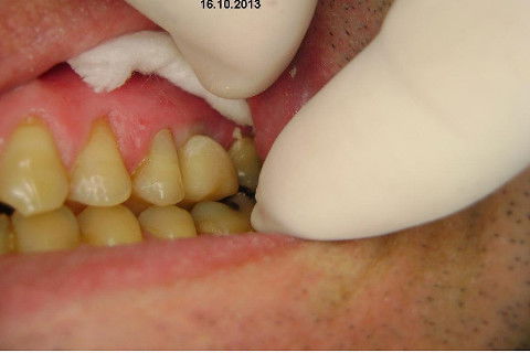 Implante Alvim Cone Morse - Instalação em 20 Minutos, Sem Retalho, Sem Sutura