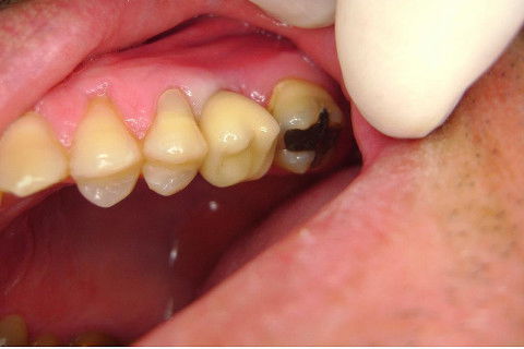 Implante Alvim Cone Morse - Instalação em 20 Minutos, Sem Retalho, Sem Sutura