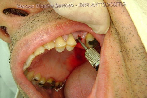 Implante Alvim Cone Morse - Instalação em 20 Minutos, Sem Retalho, Sem Sutura