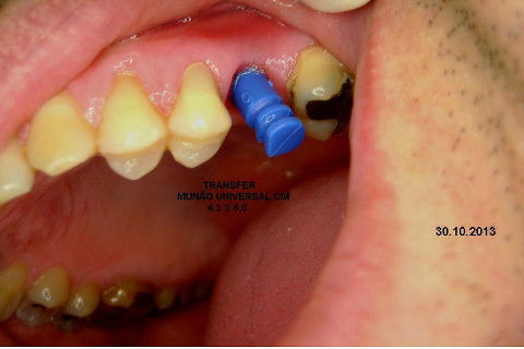 Implante Alvim Cone Morse - Instalação em 20 Minutos, Sem Retalho, Sem Sutura