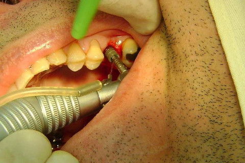 Implante Alvim Cone Morse - Instalação em 20 Minutos, Sem Retalho, Sem Sutura