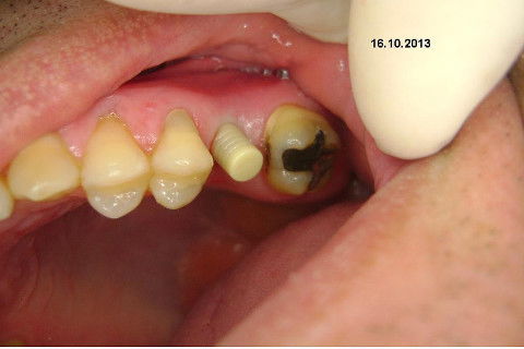 Implante Alvim Cone Morse - Instalação em 20 Minutos, Sem Retalho, Sem Sutura