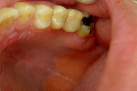 Implante Alvim Cone Morse - Instalação em 20 Minutos, Sem Retalho, Sem Sutura