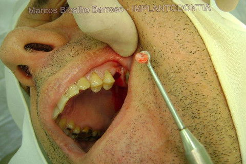 Implante Alvim Cone Morse - Instalação em 20 Minutos, Sem Retalho, Sem Sutura