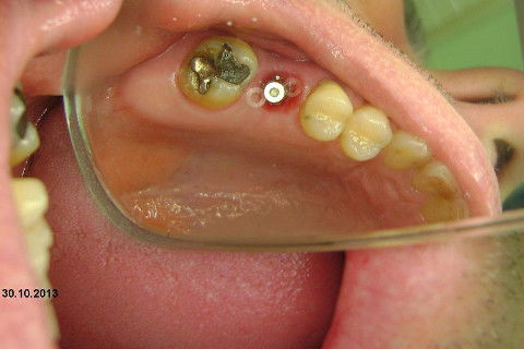 Implante Alvim Cone Morse - Instalação em 20 Minutos, Sem Retalho, Sem Sutura