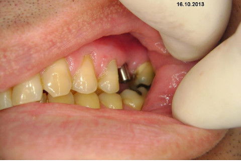 Implante Alvim Cone Morse - Instalação em 20 Minutos, Sem Retalho, Sem Sutura