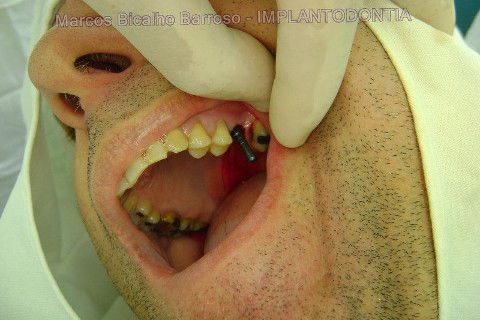 Implante Alvim Cone Morse - Instalação em 20 Minutos, Sem Retalho, Sem Sutura