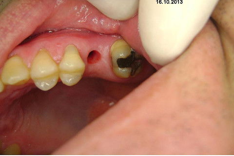 Implante Alvim Cone Morse - Instalação em 20 Minutos, Sem Retalho, Sem Sutura