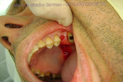 Implante Alvim Cone Morse - Instalação em 20 Minutos, Sem Retalho, Sem Sutura