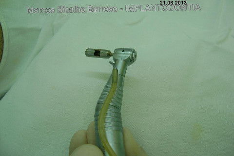 Implante Alvim Cone Morse - Instalação em 20 Minutos, Sem Retalho, Sem Sutura