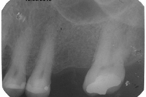 Implante Alvim Cone Morse - Instalação em 20 Minutos, Sem Retalho, Sem Sutura