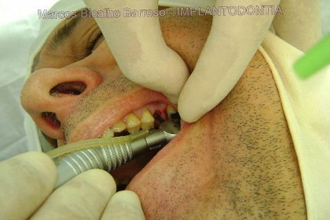 Implante Alvim Cone Morse - Instalação em 20 Minutos, Sem Retalho, Sem Sutura