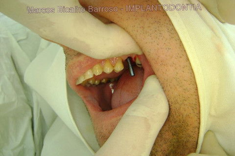 Implante Alvim Cone Morse - Instalação em 20 Minutos, Sem Retalho, Sem Sutura