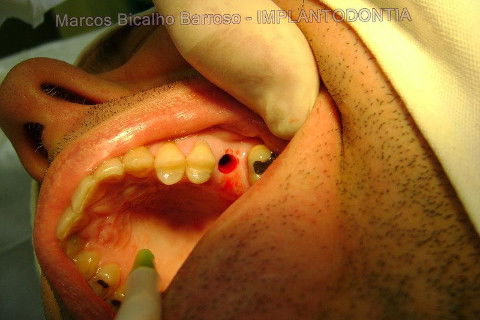 Implante Alvim Cone Morse - Instalação em 20 Minutos, Sem Retalho, Sem Sutura