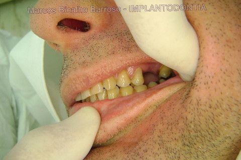 Implante Alvim Cone Morse - Instalação em 20 Minutos, Sem Retalho, Sem Sutura