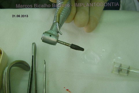 Implante Alvim Cone Morse - Instalação em 20 Minutos, Sem Retalho, Sem Sutura