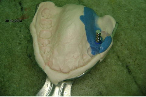 Implante Alvim Cone Morse - Instalação em 20 Minutos, Sem Retalho, Sem Sutura