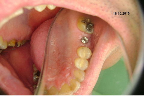 Implante Alvim Cone Morse - Instalação em 20 Minutos, Sem Retalho, Sem Sutura