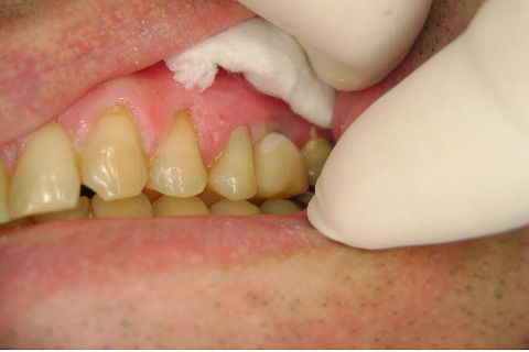 Implante Alvim Cone Morse - Instalação em 20 Minutos, Sem Retalho, Sem Sutura