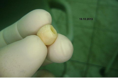 Implante Alvim Cone Morse - Instalação em 20 Minutos, Sem Retalho, Sem Sutura