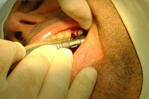 Implante Alvim Cone Morse - Instalação em 20 Minutos, Sem Retalho, Sem Sutura