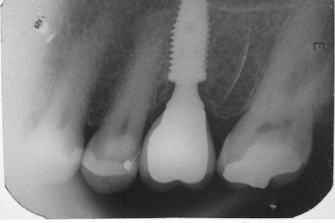 Implante Alvim Cone Morse - Instalação em 20 Minutos, Sem Retalho, Sem Sutura