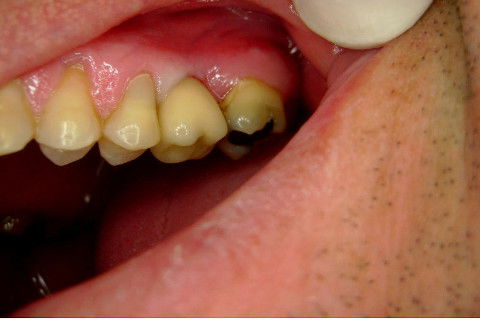 Implante Alvim Cone Morse - Instalação em 20 Minutos, Sem Retalho, Sem Sutura
