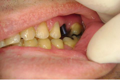 Implante Alvim Cone Morse - Instalação em 20 Minutos, Sem Retalho, Sem Sutura