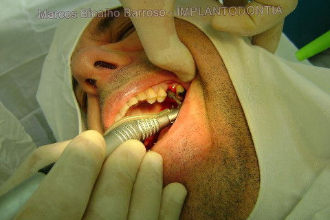 Implante Alvim Cone Morse - Instalação em 20 Minutos, Sem Retalho, Sem Sutura