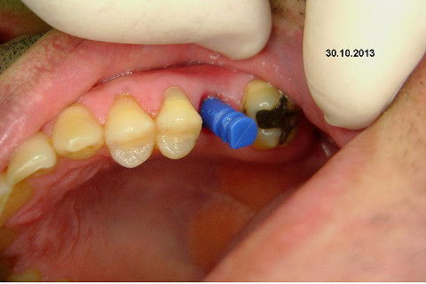 Implante Alvim Cone Morse - Instalação em 20 Minutos, Sem Retalho, Sem Sutura
