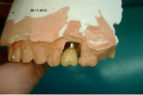 Implante Alvim Cone Morse - Instalação em 20 Minutos, Sem Retalho, Sem Sutura