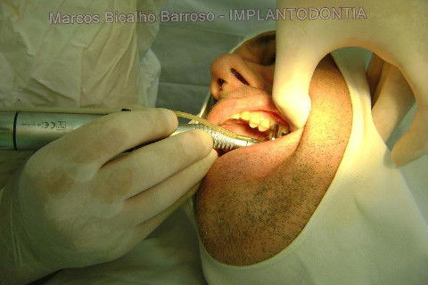 Implante Alvim Cone Morse - Instalação em 20 Minutos, Sem Retalho, Sem Sutura