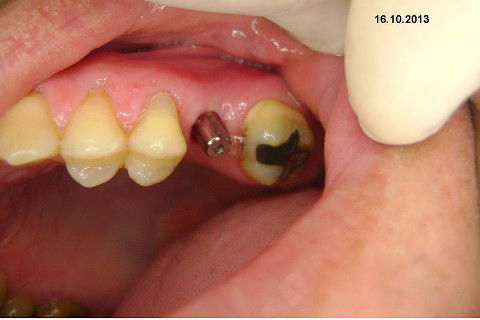 Implante Alvim Cone Morse - Instalação em 20 Minutos, Sem Retalho, Sem Sutura