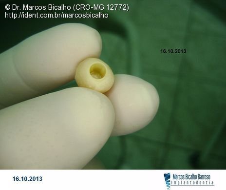 Implante Alvim Cone Morse - Instalação em 20 Minutos, Sem Retalho, Sem Sutura