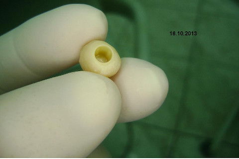 Implante Alvim Cone Morse - Instalação em 20 Minutos, Sem Retalho, Sem Sutura