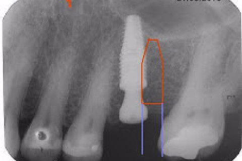 Posicionamento do implante de acordo com o espaço protético.