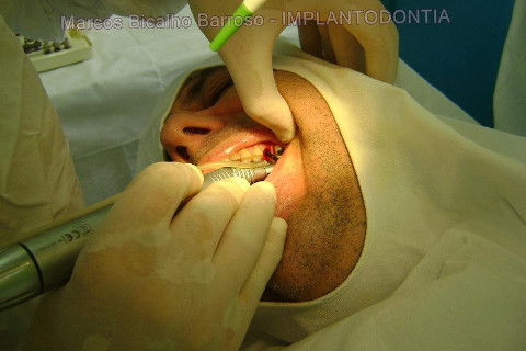 Implante Alvim Cone Morse - Instalação em 20 Minutos, Sem Retalho, Sem Sutura