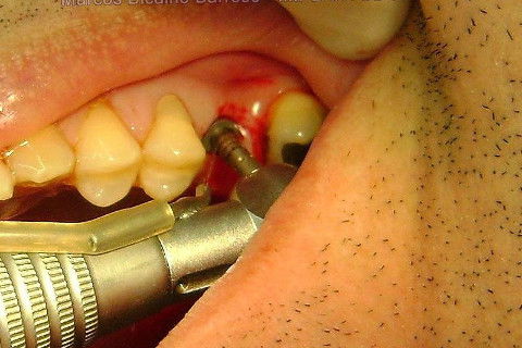 Implante Alvim Cone Morse - Instalação em 20 Minutos, Sem Retalho, Sem Sutura