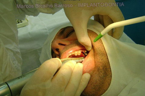 Implante Alvim Cone Morse - Instalação em 20 Minutos, Sem Retalho, Sem Sutura