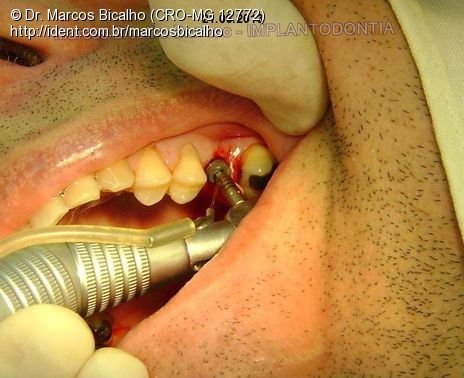 Implante Alvim Cone Morse - Instalação em 20 Minutos, Sem Retalho, Sem Sutura